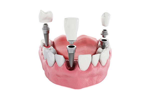 Prótesis sobre implantes